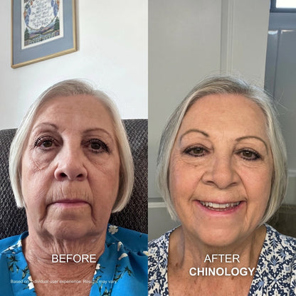 The Chinology™ Lift  (New Version - 2026)