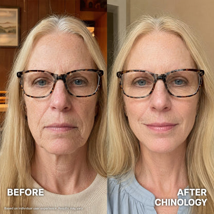 The Chinology™ Lift  (New Version - 2026)